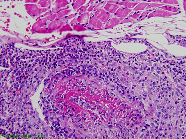 Churg-Strauss arteritis involving epimysial artery, H&E stain x 200